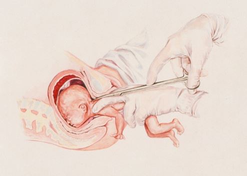 avortement-naissance-partielle-v1.JPG